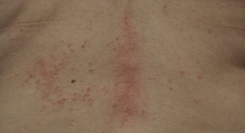 Pacientes com dermatomiosite podem ter mortalidade maior